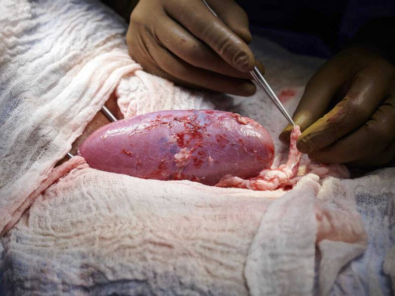 In a major scientific advance, a pig kidney is successfully transplanted into a human