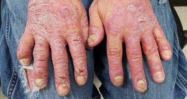 Dermatitis: Health Risks Of Being A Chef(Read)