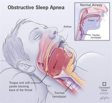 What Is Obstructive Sleep Apnea? Sleep Apnea Is A Serious Sleep Disorder 