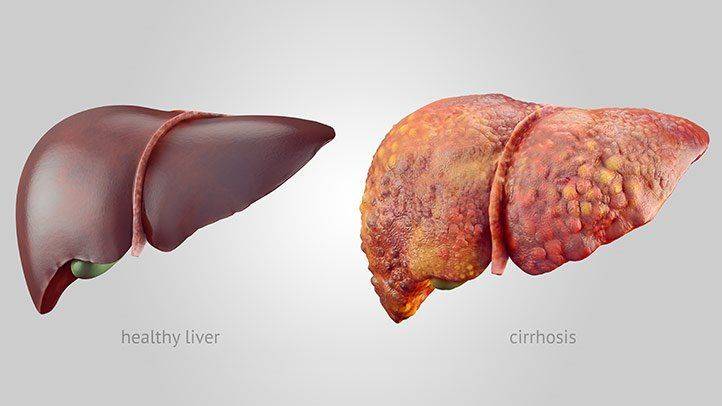 Two Main Causes Of Fatty Liver Diseases(And What You Need To Know)