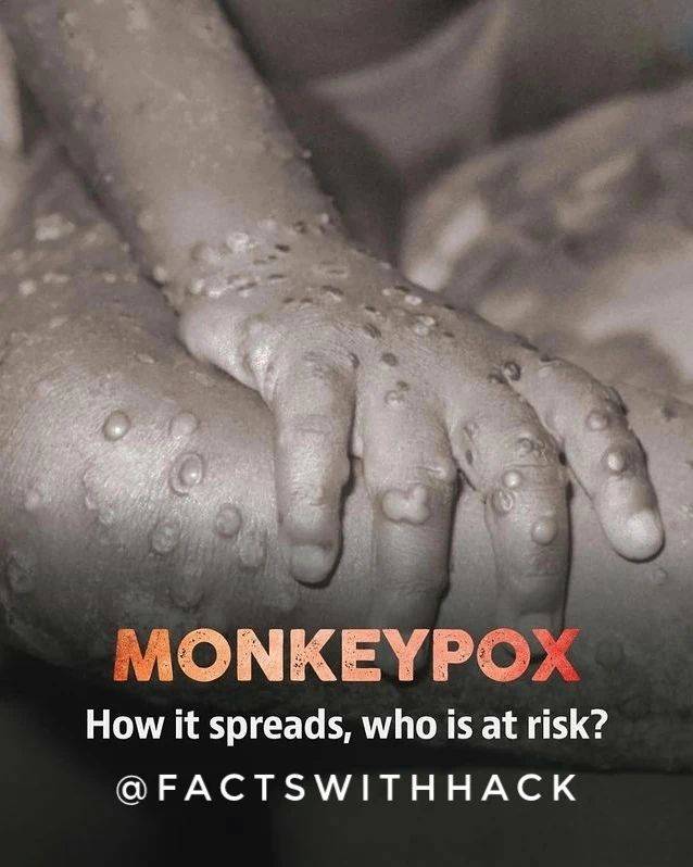 Monkeypox - “Immense Frustration”