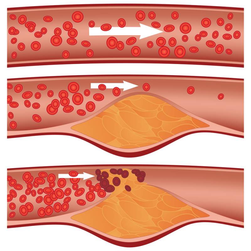 CRISPR Cures High Cholesterol Enters First Human Trial