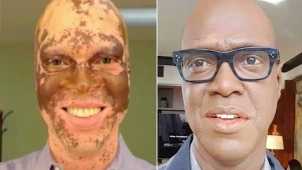 The Difference between depigmentation and vitiligo 