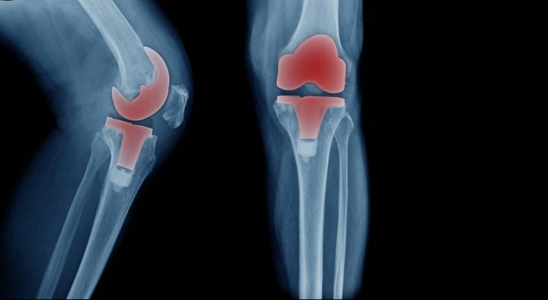 How Knee Replacements Work