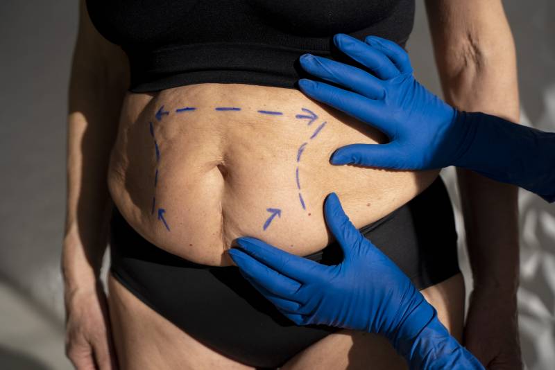 Ideal Tummy Tuck Patient & Amazing Results