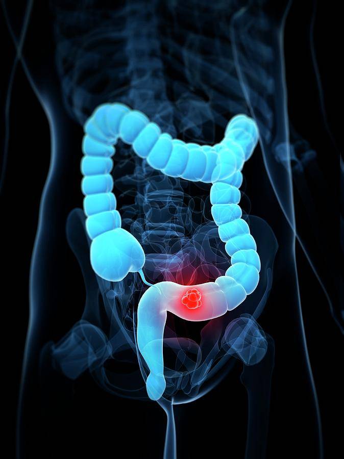 Got Screened for Colon Cancer