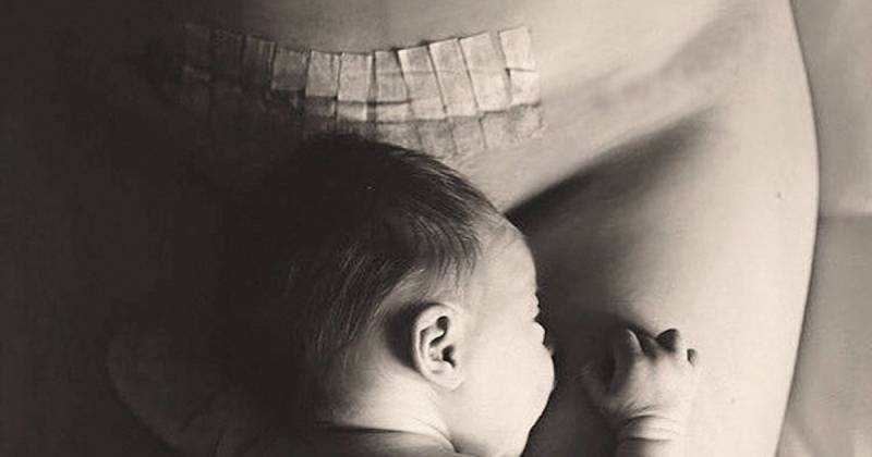 C-Section Procedure - What to Expect During Surgery