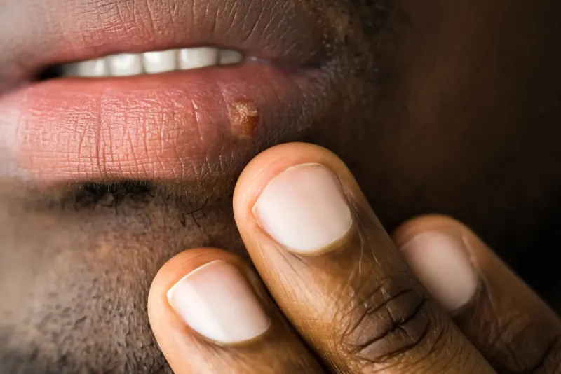 Herpes: Why It HIDES in Your Nerves Forever