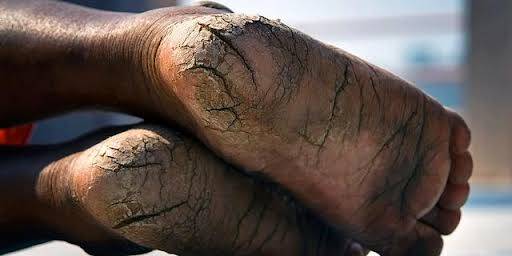 Healing Cracked Skin, Fungus, and Warts