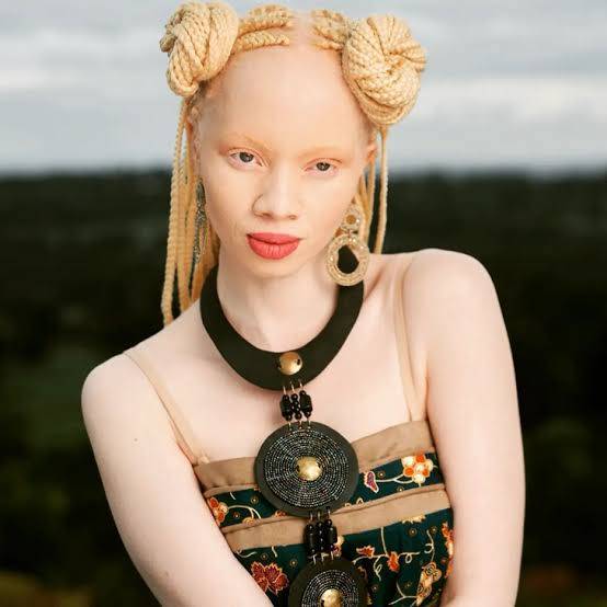 Living With Albinism in Nigeria: The Honest Bunch Podcast