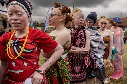 Living With Albinism in Nigeria: The Honest Bunch Podcast